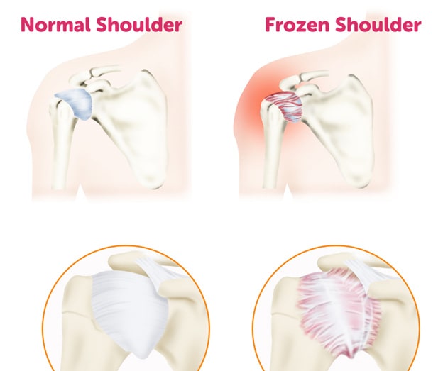 Is Physiotherapy Effective for Frozen Shoulder